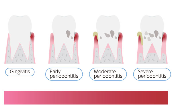 stages of gum disease