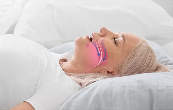 obstructive sleep apnea