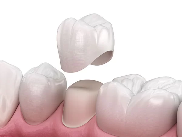 dental crown; cap; tooth crown