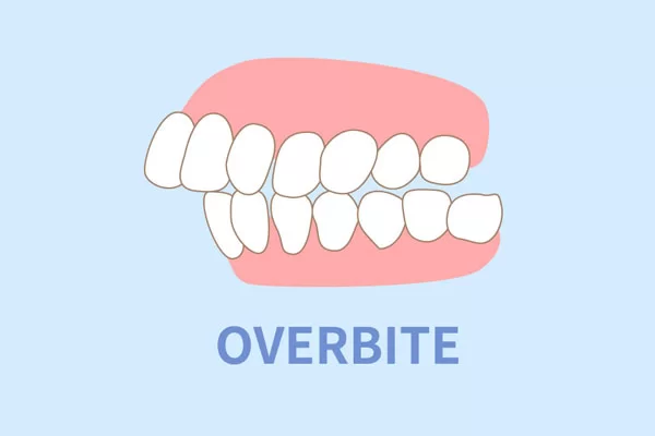 overbite