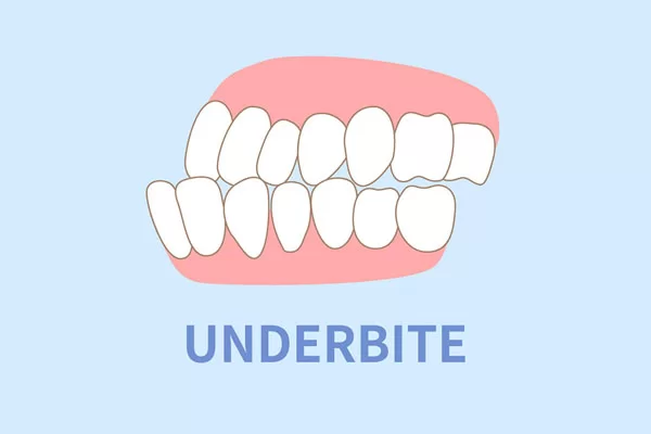 underbites